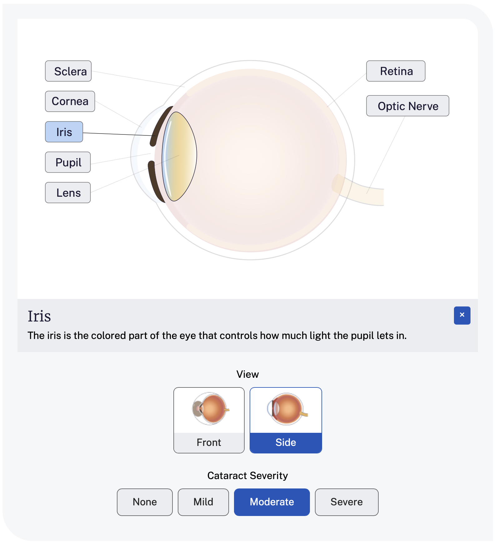 An interactive eye graphic that shows the side view of an eyeball with cataracts progression. The stages of disease progression are "none, mild, moderate, severe" and severe is selected. The iris is highlighted and a caption explains this part of the eye.
