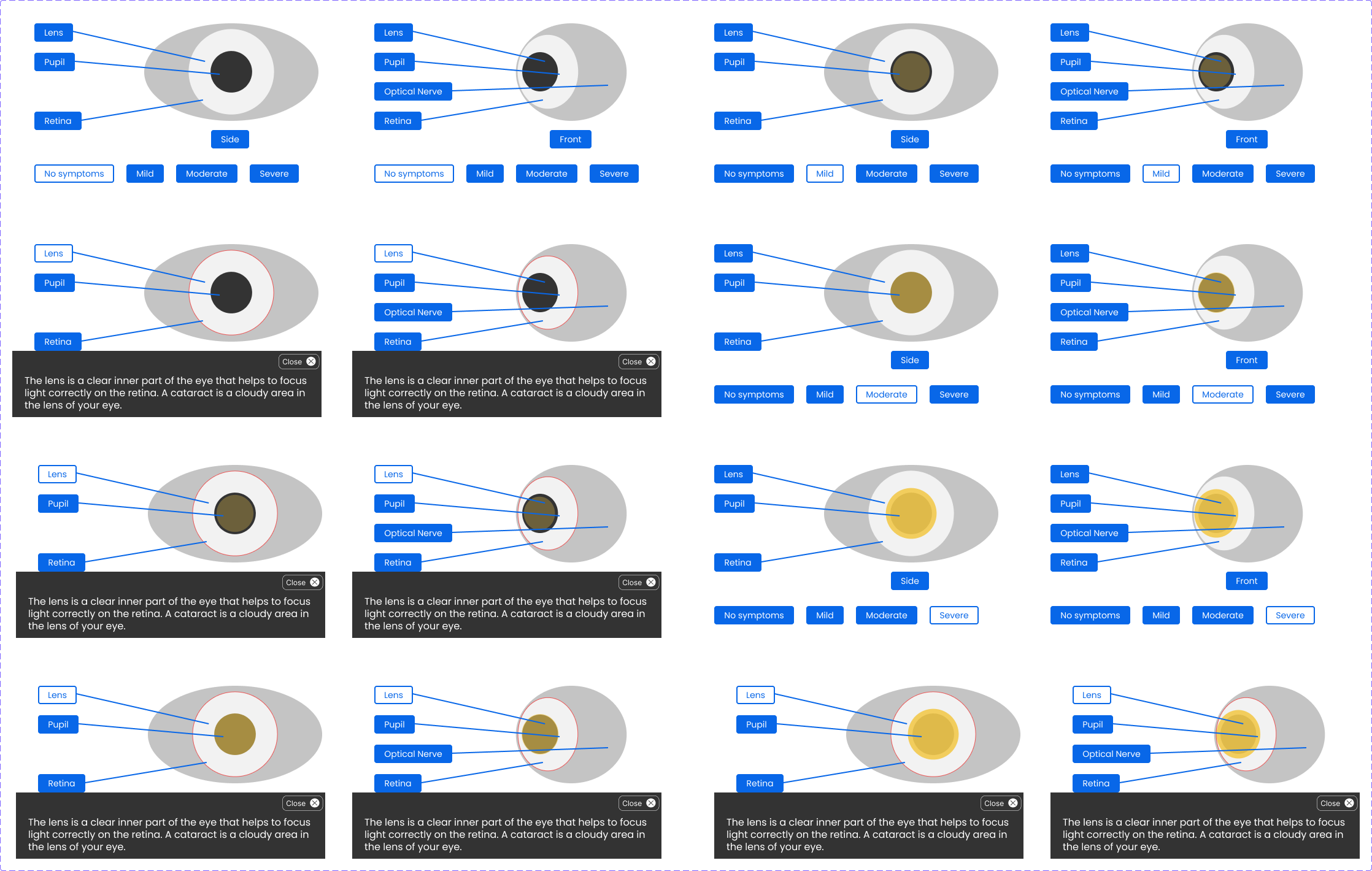 Wireframes for an interactive eye graphic. 16 different states are shown. The eye is oriented differently in some. There are different parts highlighted and described. And, various stages of disease severity are shown.