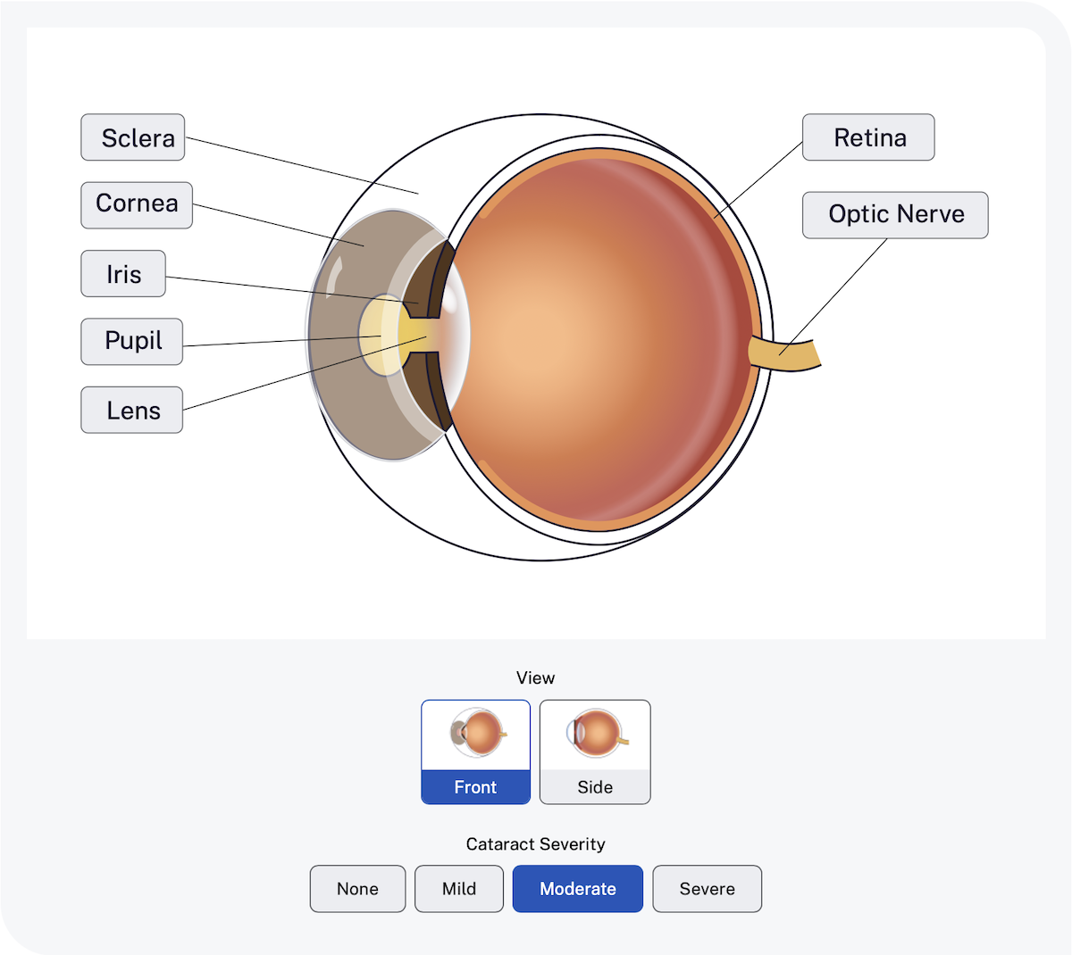 A screenshot of the interactive eye graphic. An anatomic drawing of the eye is showing a cross-section of a quarter turned eyeball. All the parts are labeled. The graphic can be manipulated to change the angle, highlight different parts, see descriptions, and change the severity of the disease that's illustrated, in this case cataract.